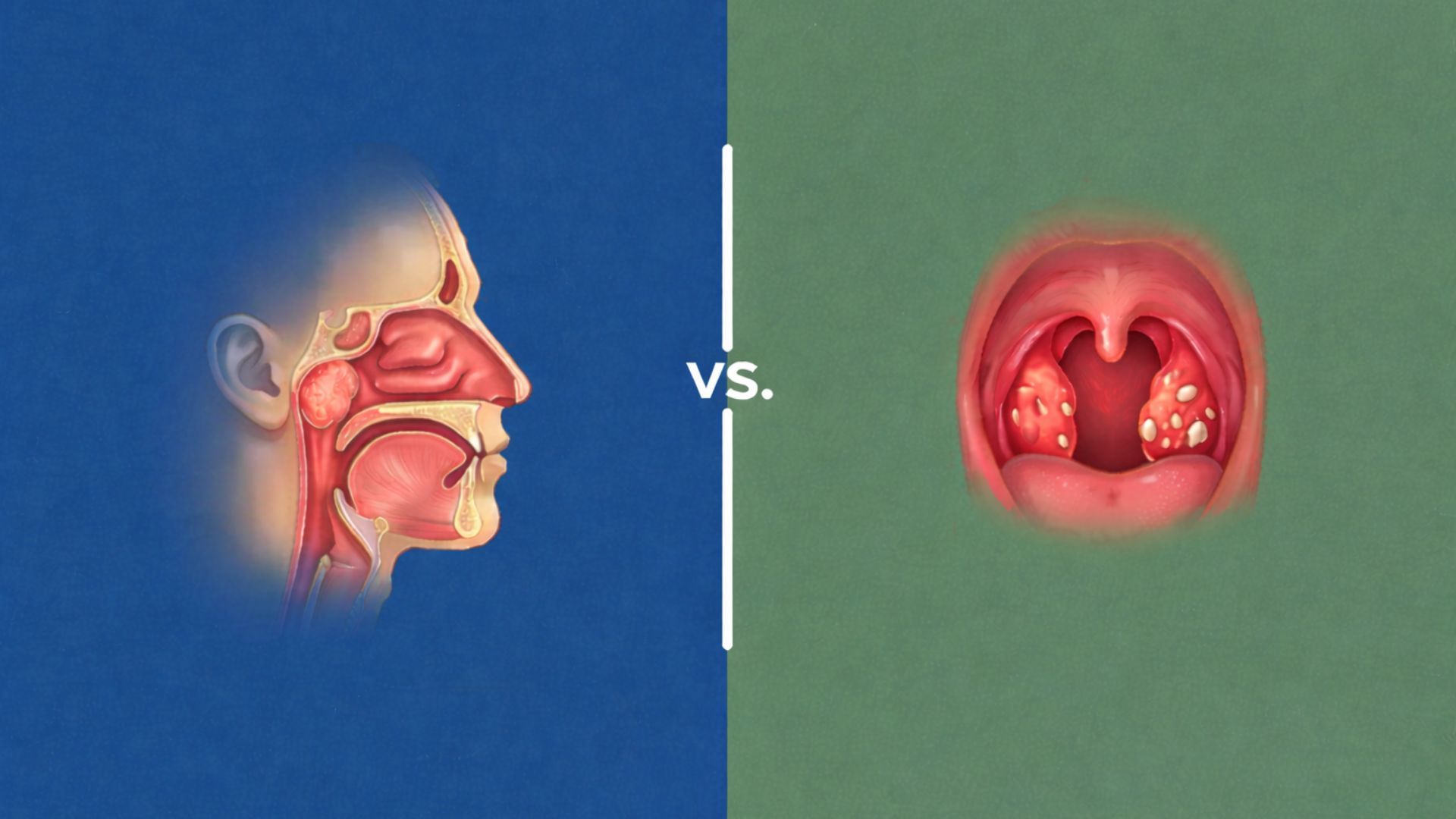 Adenoid vs. Tonsil