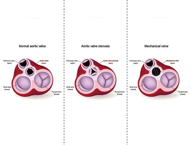 Aortic Valve Replacement - Understanding Surgical and Minimally Invasive Approaches