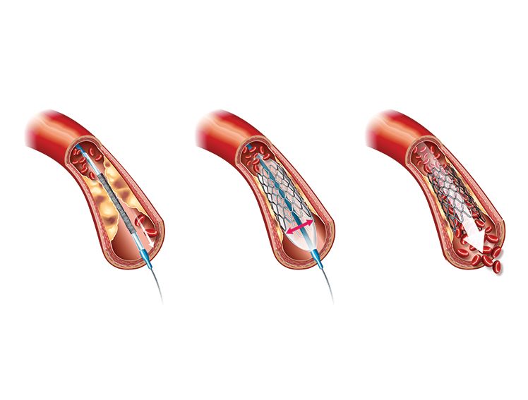 BIORESORBABLE SCAFFOLDS - The New Age Dissolving Stents