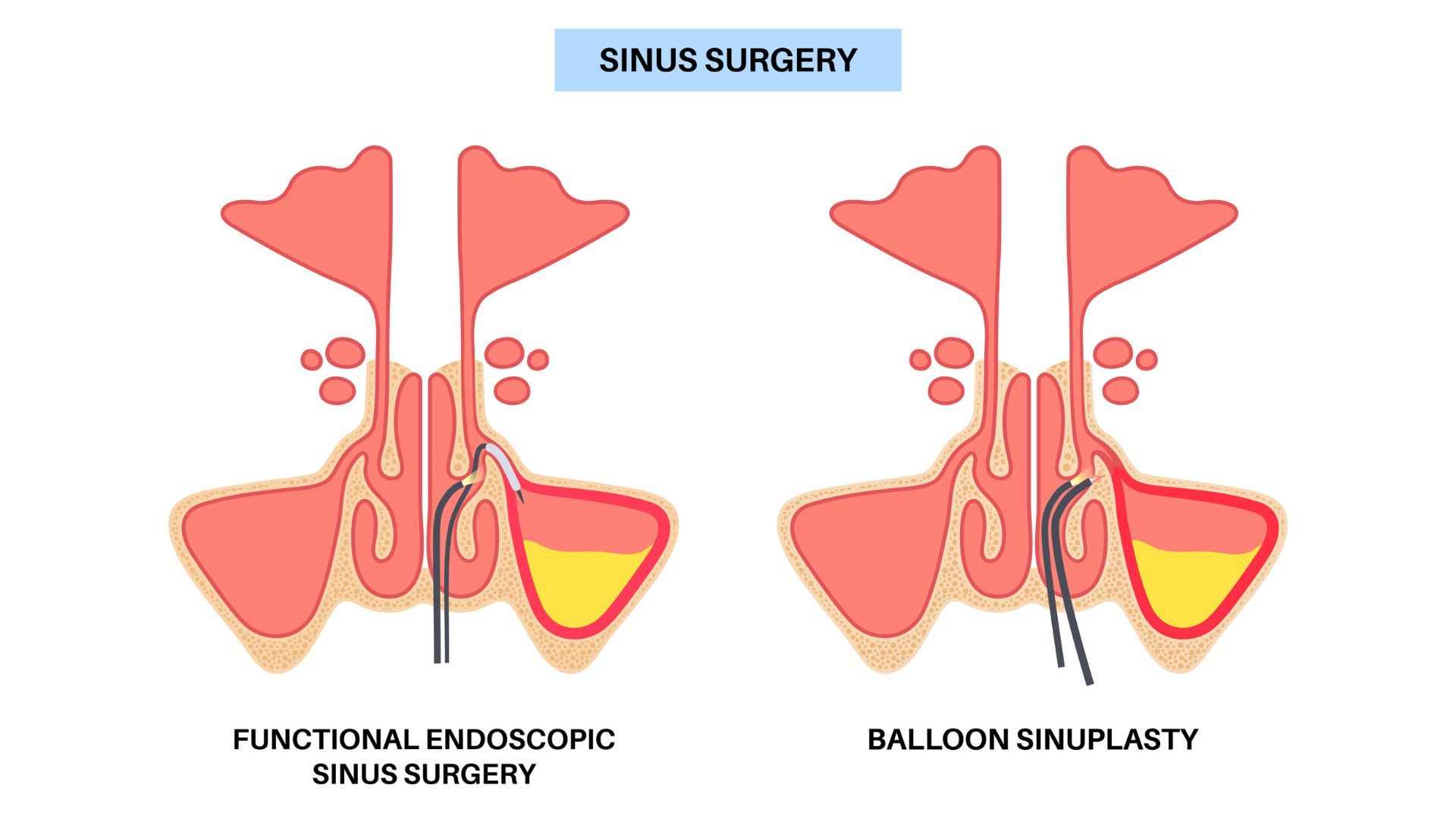 Balloon Sinuplasty vs Sinus Surgery (FESS)