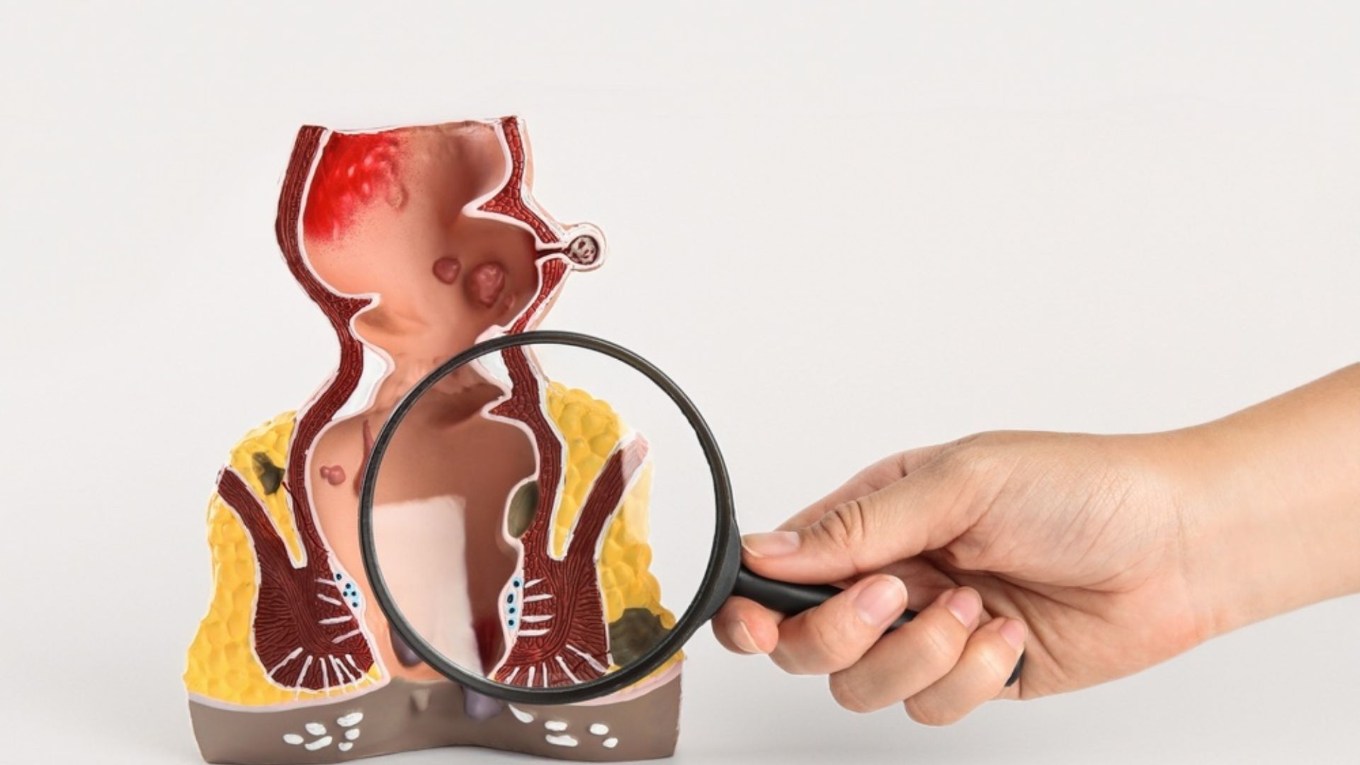 Fistula Types & Treatments