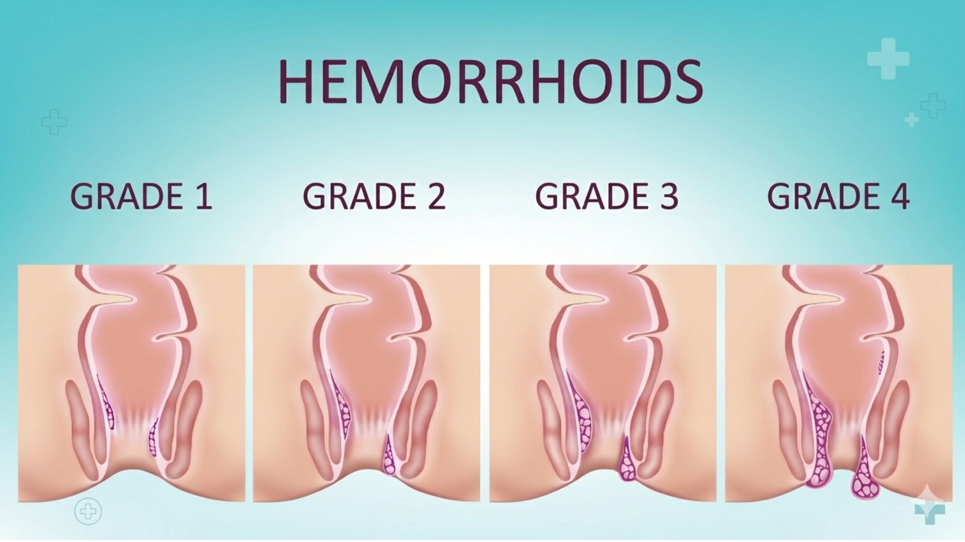 Grades of Piles: Grade 1 to Grade 4 Explained