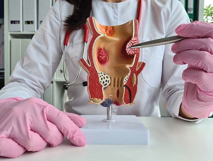 Hemorrhoidectomy