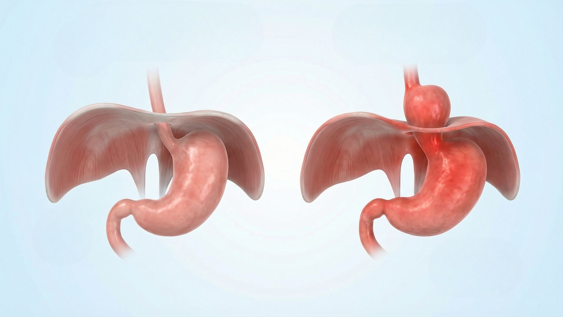 Hiatal Hernia