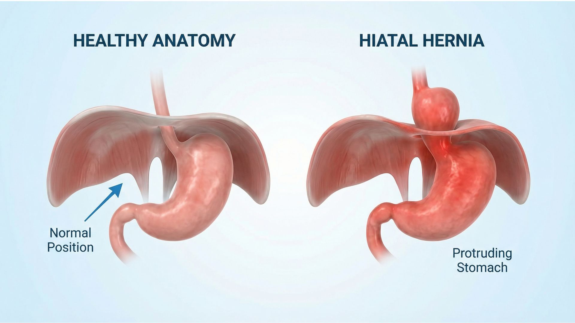 Hiatal Hernia: Symptoms, Diagnosis, and Treatment Options