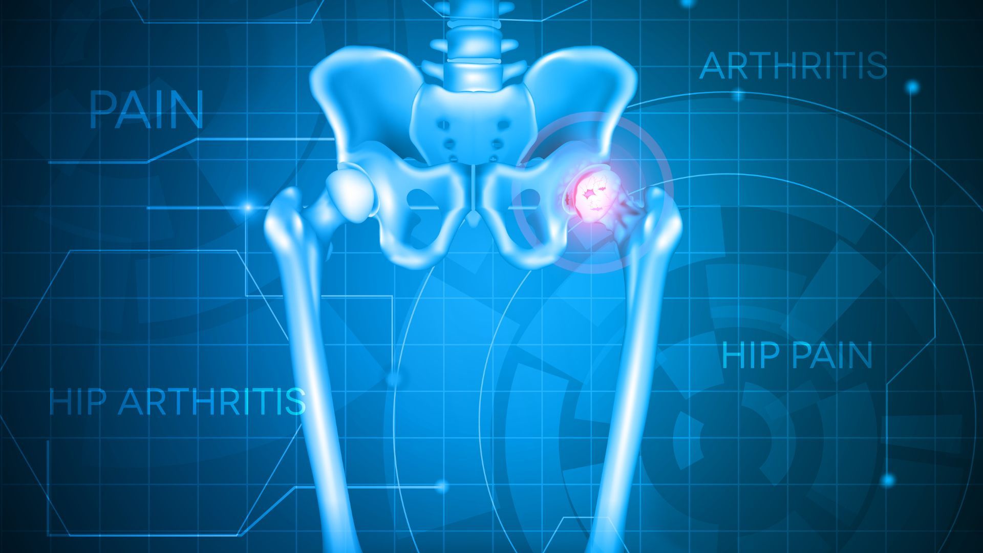 Hip Replacement Surgery: Procedure, Implant Types & Recovery Tips