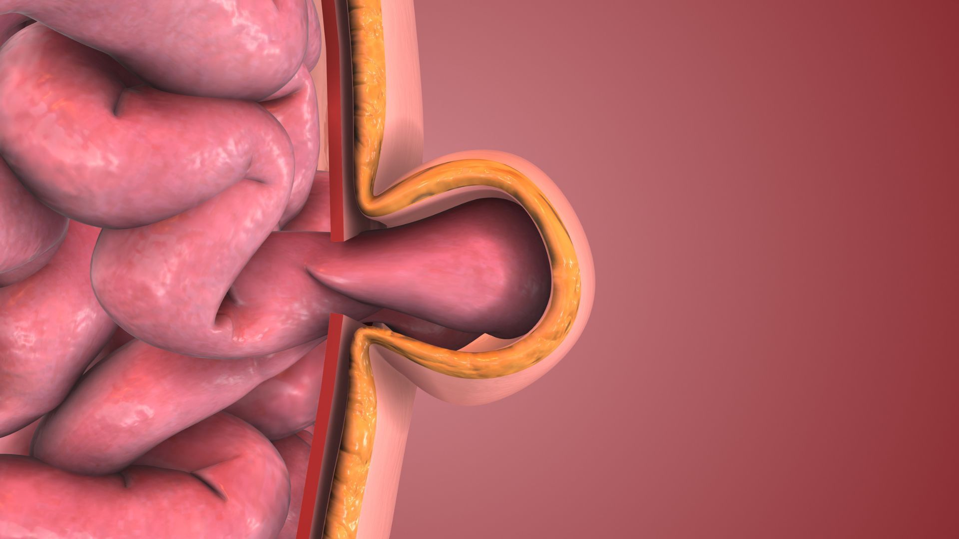 How a Hernia Develops Over Time: From Weak Muscle to Surgical Condition