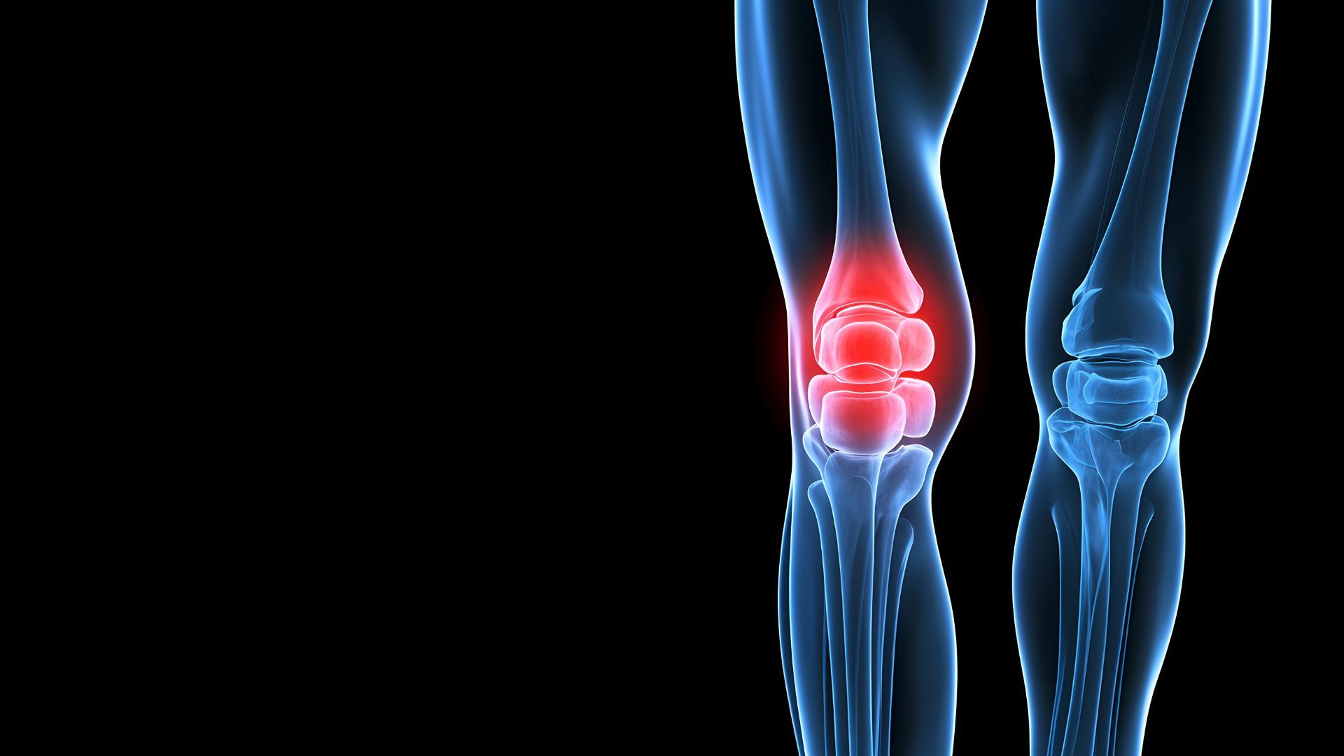 Joint Replacement Surgery and COVID-19
