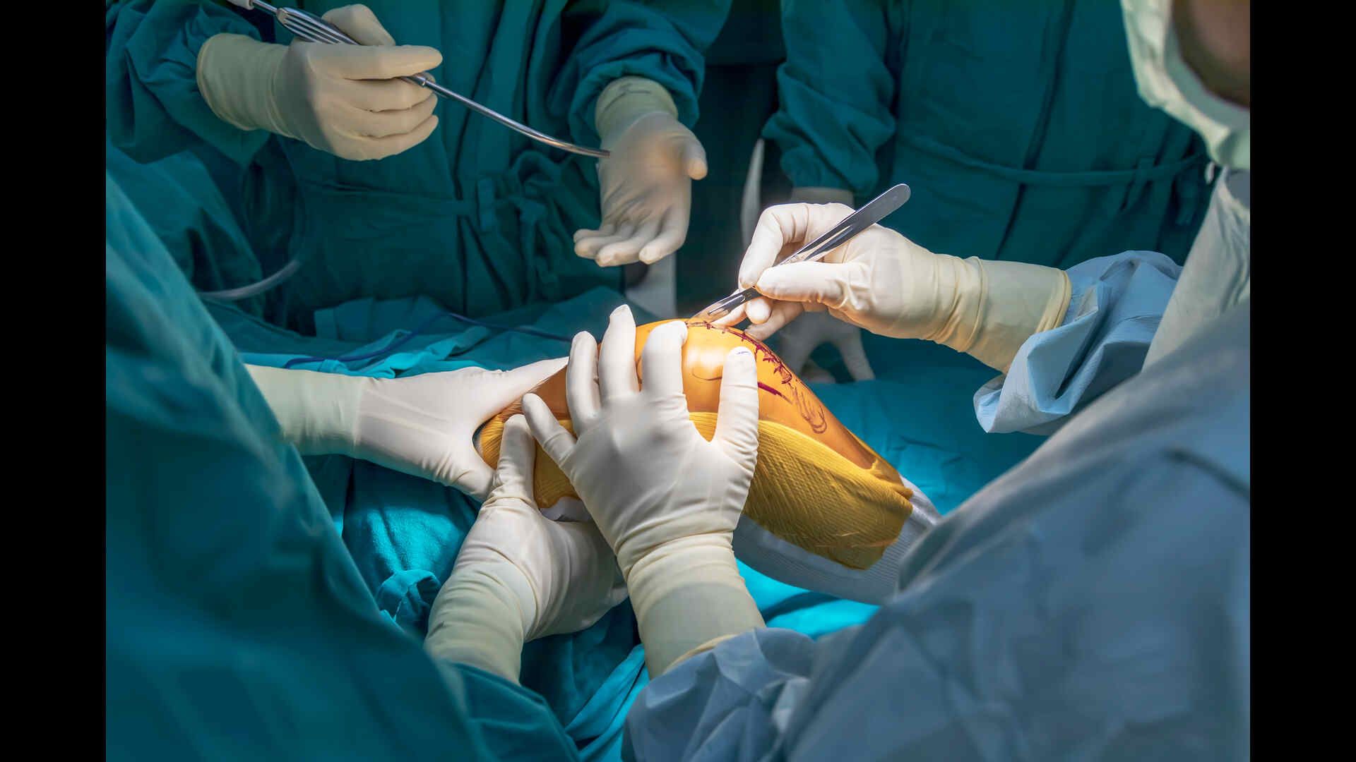 Knee Replacement Surgery: Types, Implants, Procedures, Recovery