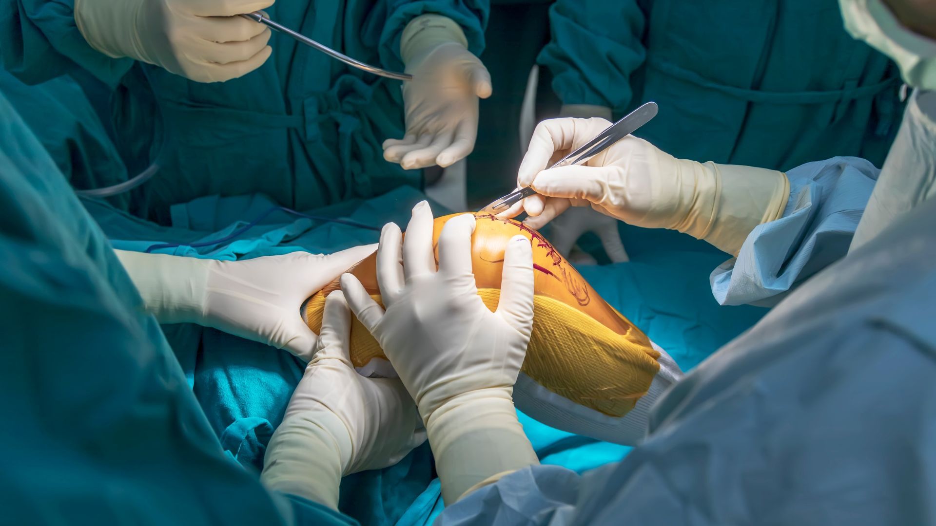 Knee Replacement Surgery: Types, Implants, Procedures, Recovery