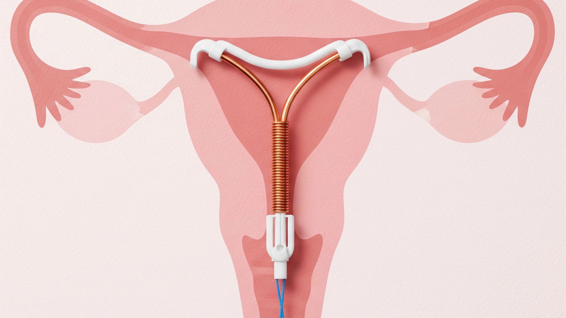 Non-Hormonal Copper IUD