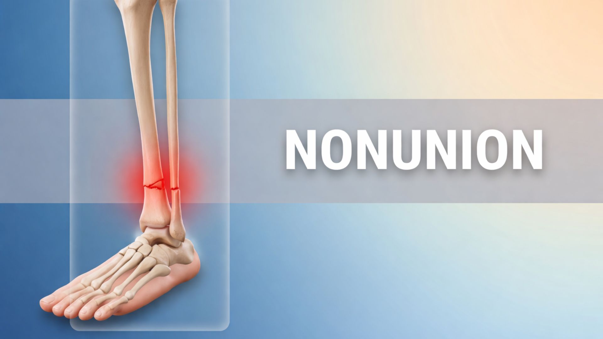 Nonunion: Why Your Bone Isn't Healing After an Injury?
