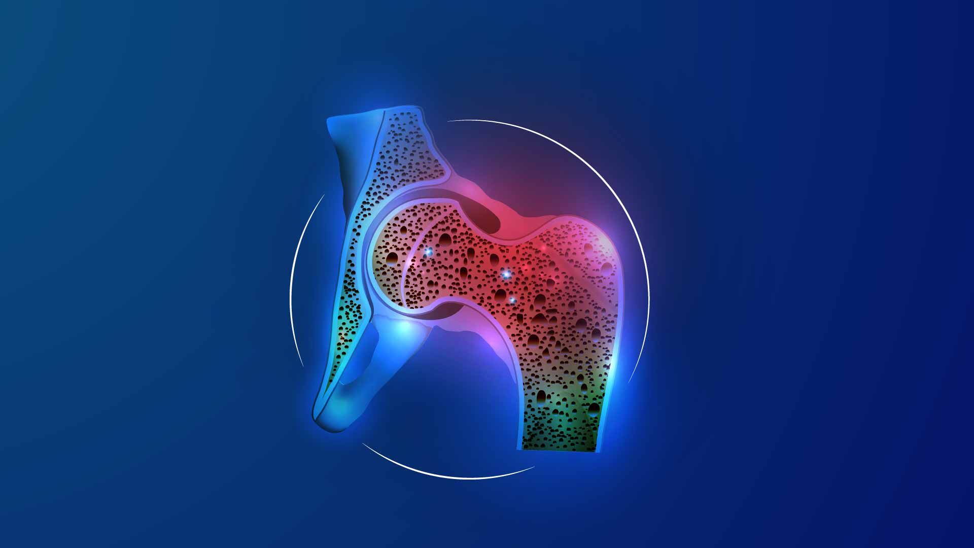 Decoding Osteoporosis: Early Care for Stronger Bones and Healthier Life