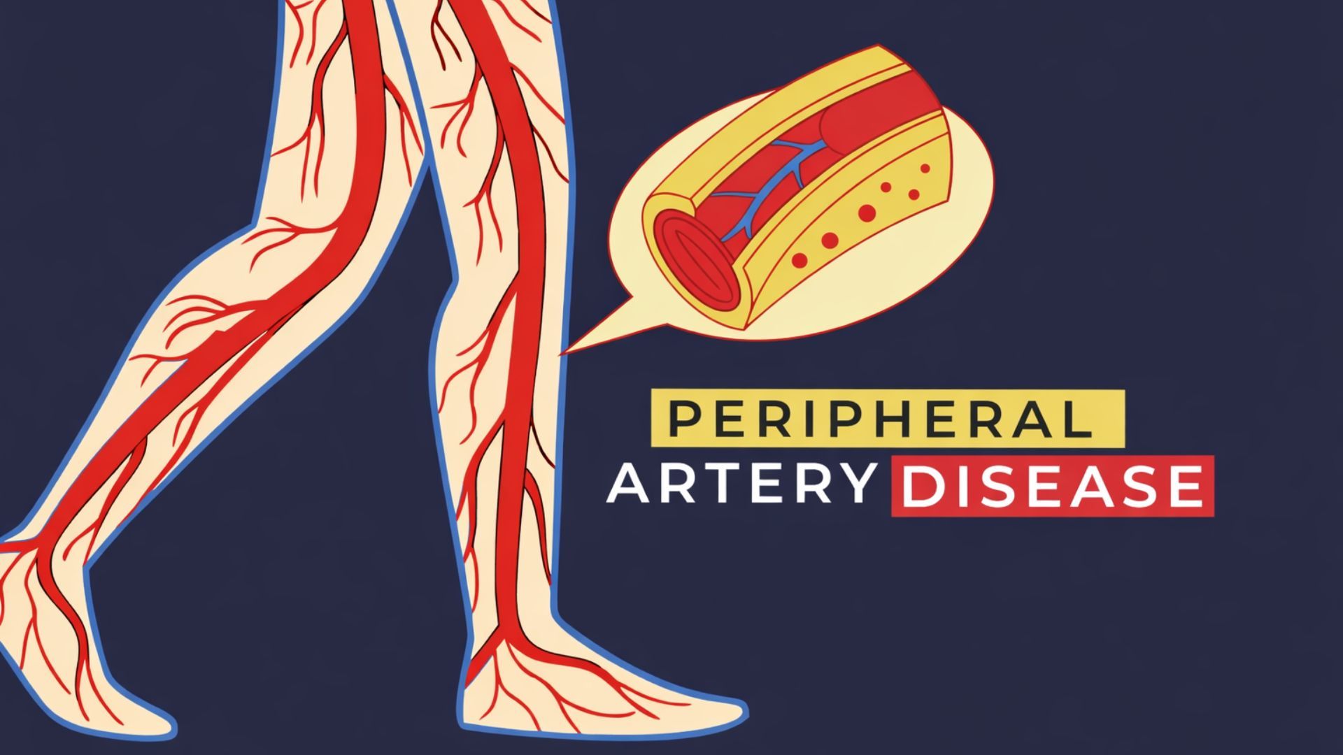 What Is Restenosis in Peripheral Artery Disease? Causes and Symptoms