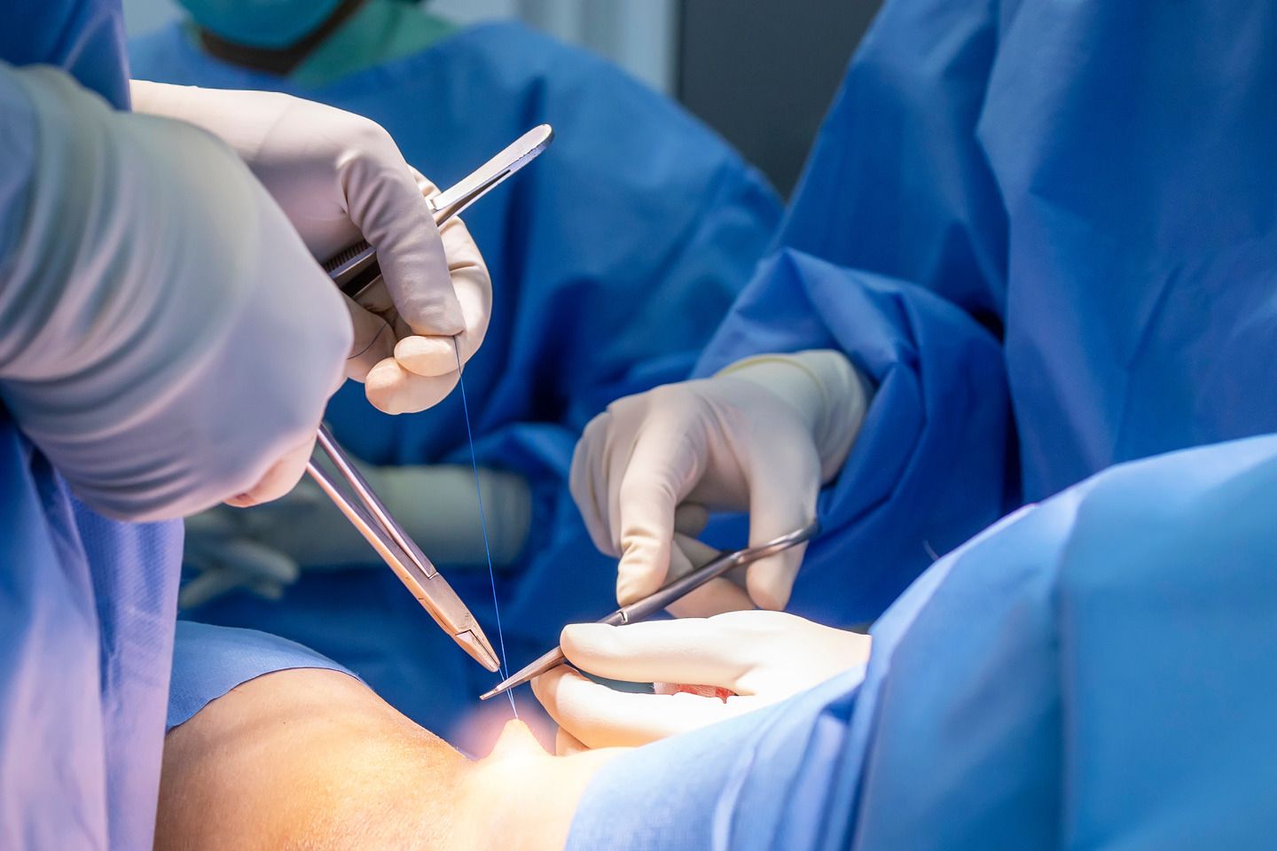 Preventing Infections with Sutures: Essential Do's and Don'ts 