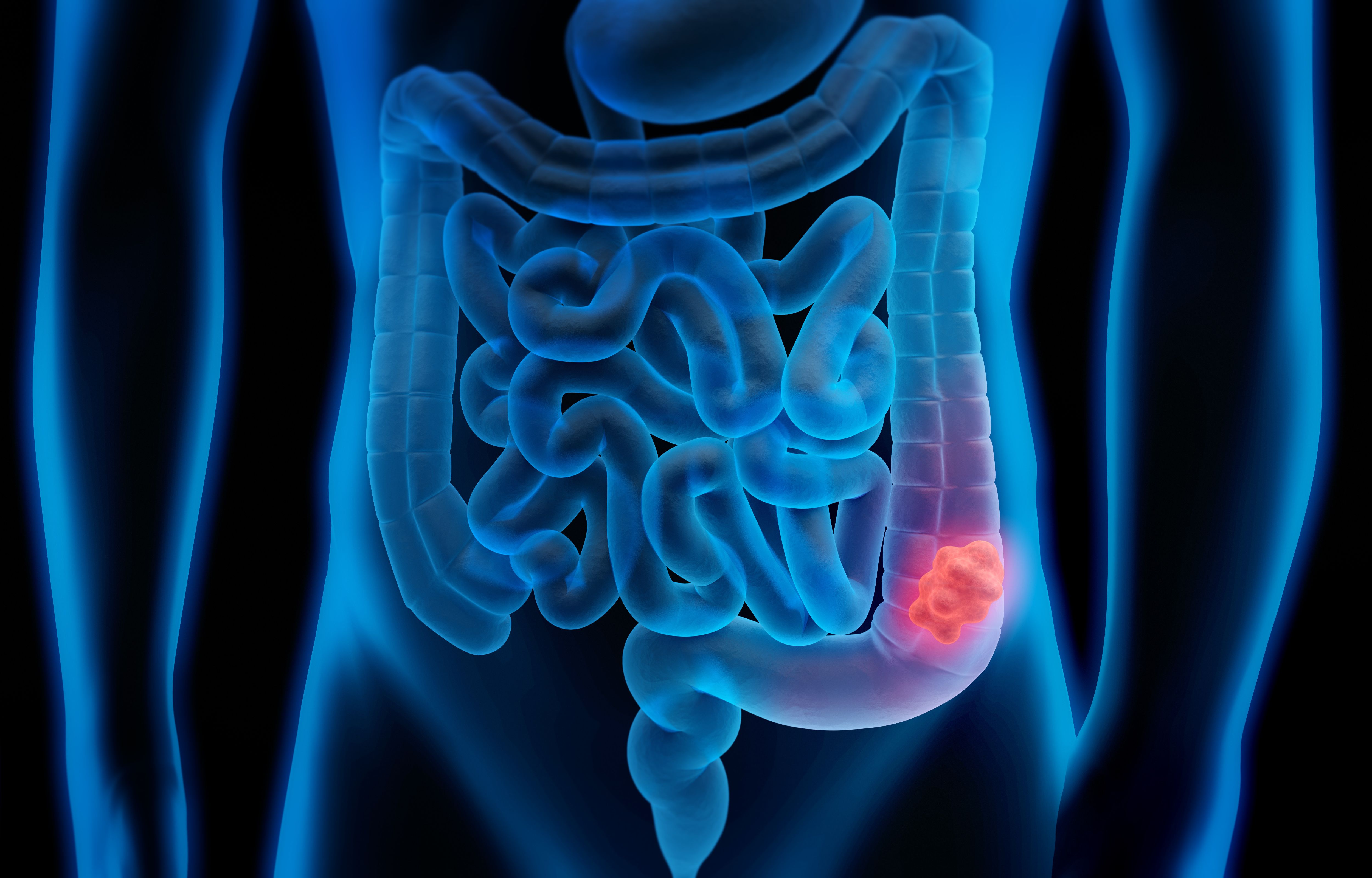 How Colon Cancer is Detected?
