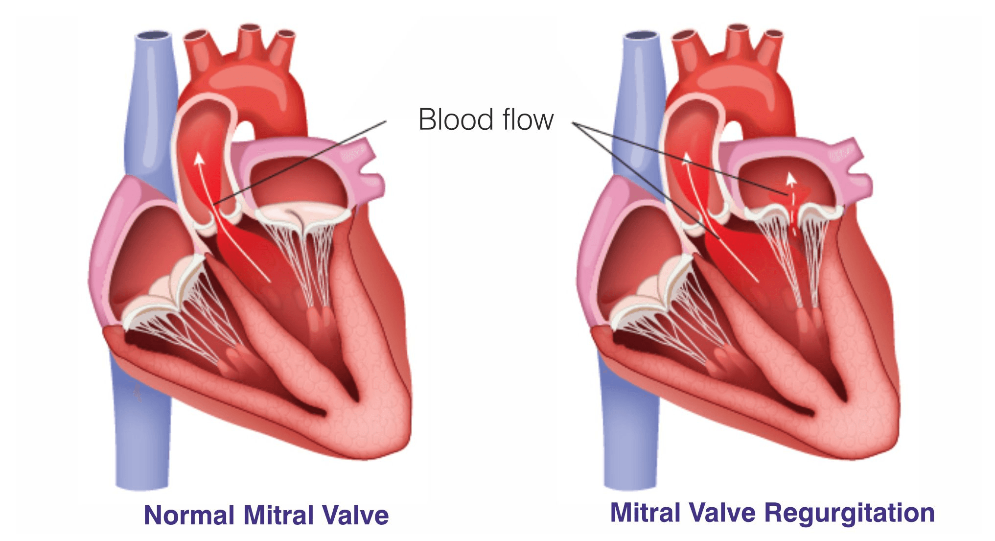 mitral valve regurgitation