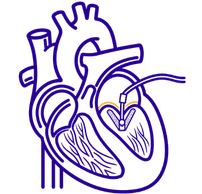 Mitral Valve Transcatheter Edge to Edge Repair