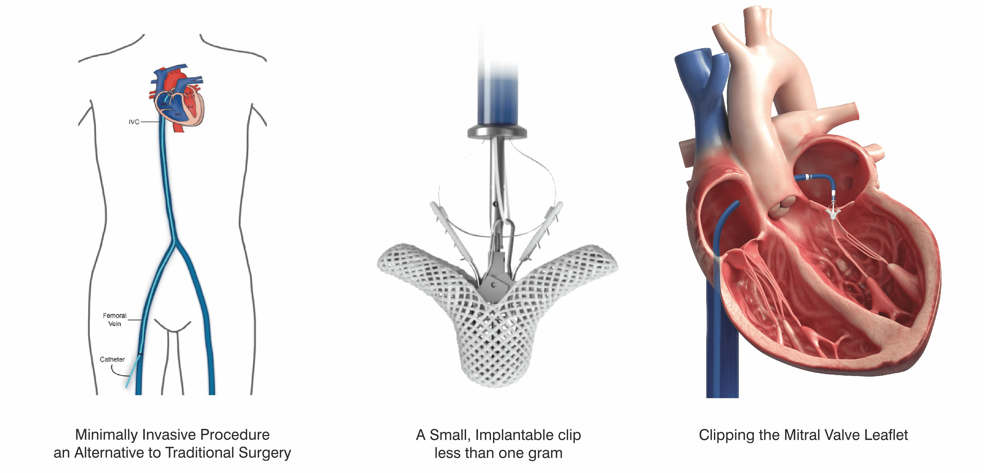 transcatheter edge to edge repair (teer)