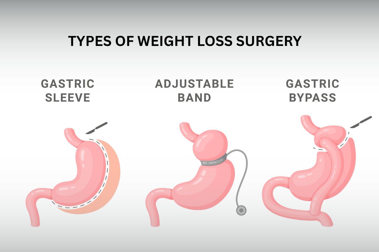 Types of Weight Loss Surgery for Obesity